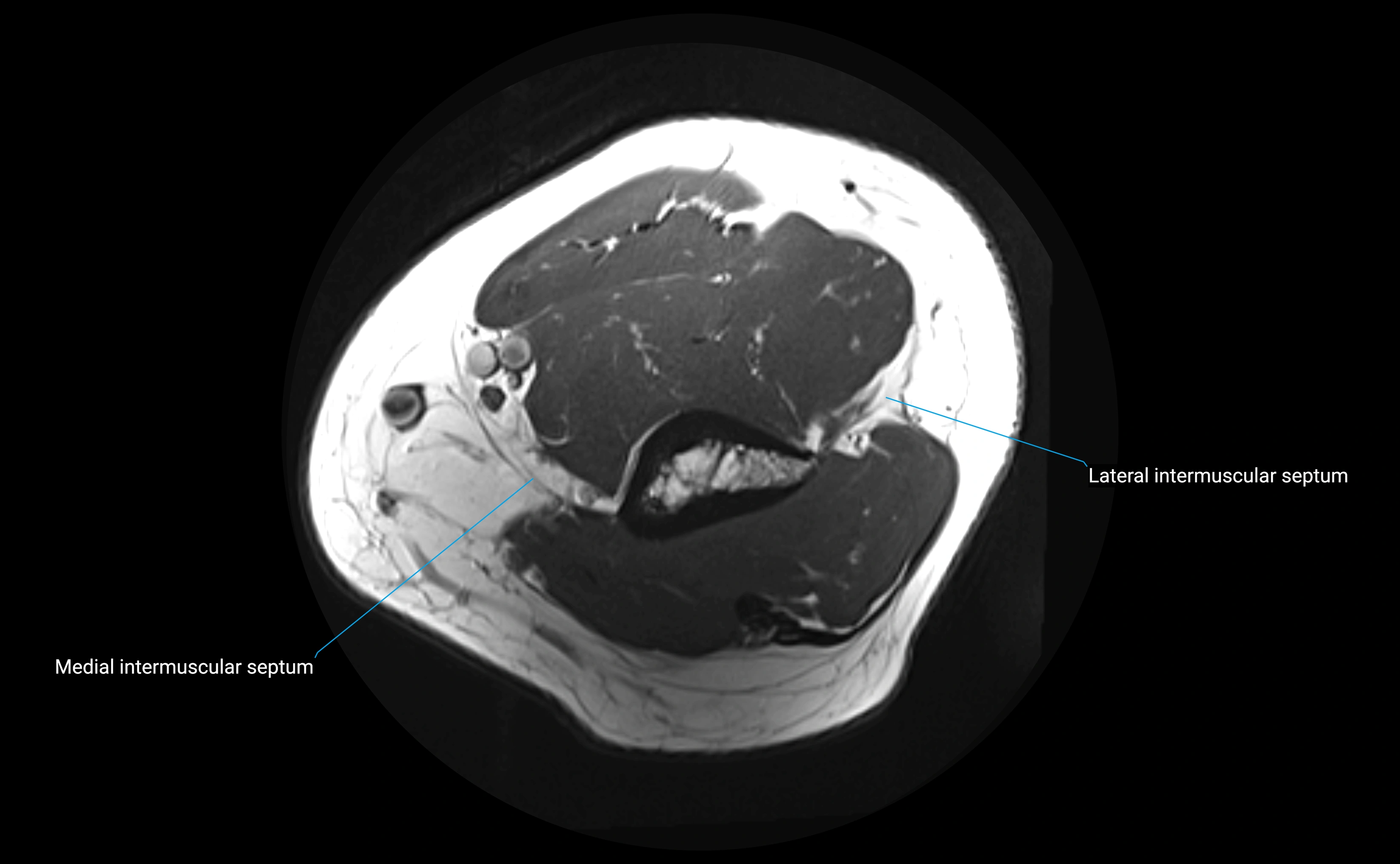 MRI elbow ligaments axial cross sectional anatomy 3T  radiology  image-img-00001-00003.webp